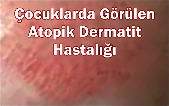 Çocuklarda Görülen Atopik Dermatit Hastalığı