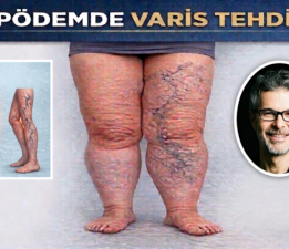 Lipödemli Hastalarda Varis Sorunu: Tedavide Öncelik N e Olmalı?