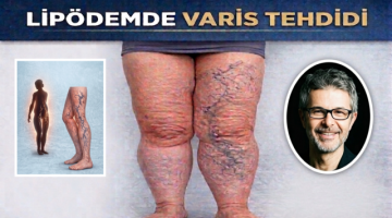 Lipödemli Hastalarda Varis Sorunu: Tedavide Öncelik N e Olmalı?
